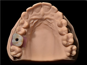 Implant  single  crowns